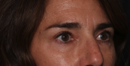 Blepharoplasty Before & After Patient #35585