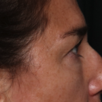 Blepharoplasty Before & After Patient #35585