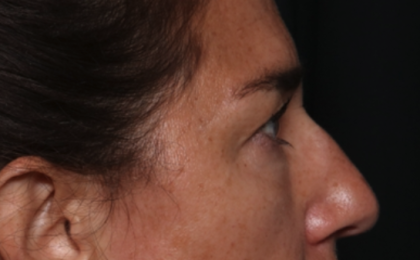 Blepharoplasty Before & After Patient #35585