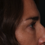 Blepharoplasty Before & After Patient #35585