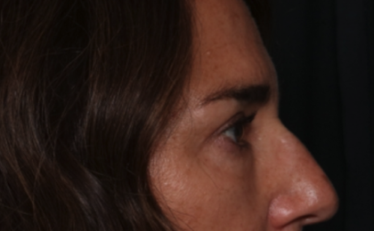 Blepharoplasty Before & After Patient #35585