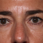 Blepharoplasty Before & After Patient #35585