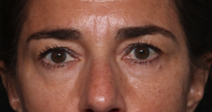 Blepharoplasty Before & After Patient #35585