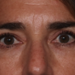 Blepharoplasty Before & After Patient #35585