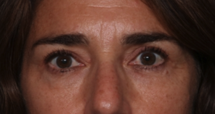 Blepharoplasty Before & After Patient #35585