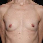 Breast Augmentation Before & After Patient #35647