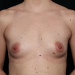 Breast Augmentation Before & After Patient #35669