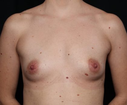 Breast Augmentation Before & After Patient #35669