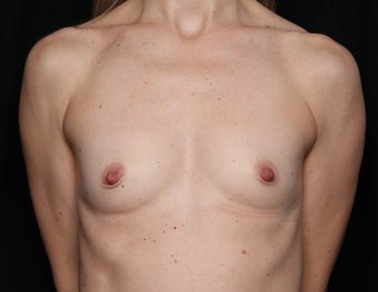 Breast Augmentation Before & After Patient #35647