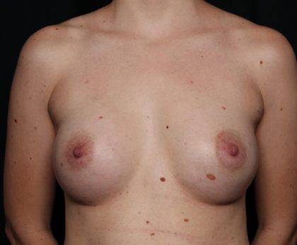 Breast Augmentation Before & After Patient #35669