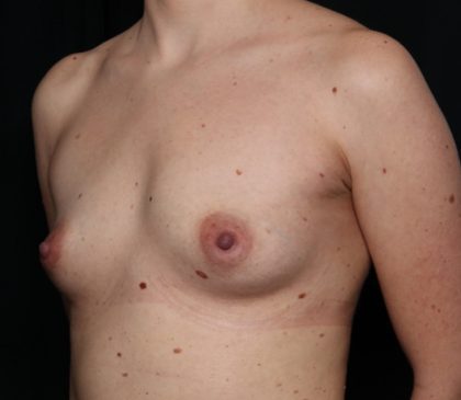 Breast Augmentation Before & After Patient #35669