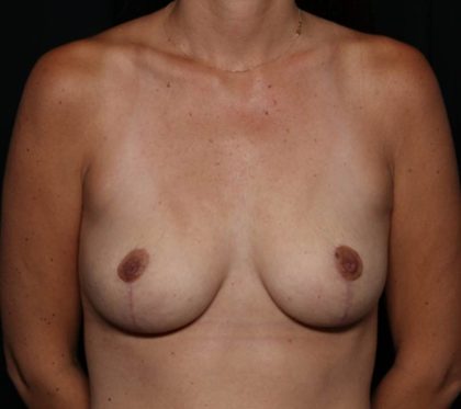 Breast Lift Before & After Patient #35614