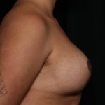 Breast Augmentation Before & After Patient #35636
