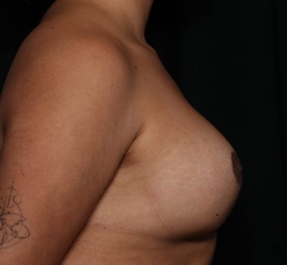Breast Augmentation Before & After Patient #35636