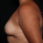 Breast Augmentation Before & After Patient #35636