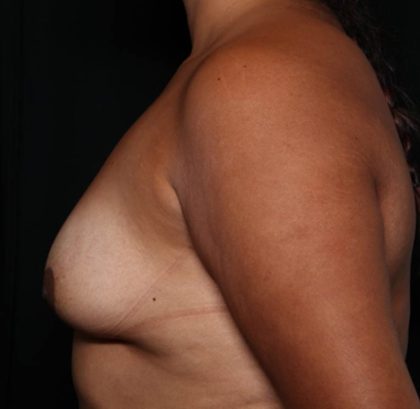 Breast Augmentation Before & After Patient #35636
