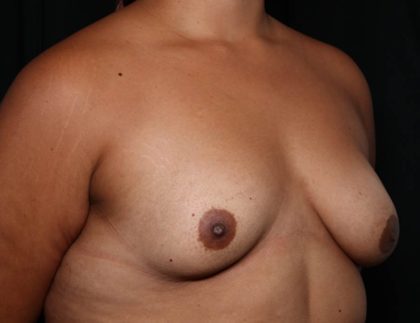 Breast Augmentation Before & After Patient #35636