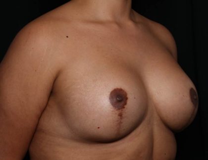 Breast Augmentation Before & After Patient #35636