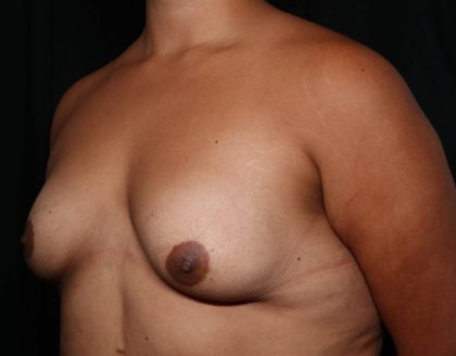 Breast Augmentation Before & After Patient #35636