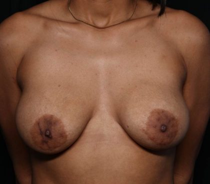 Breast Implant Exchange Before & After Patient #35625