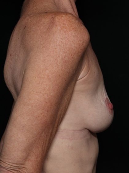 Breast Lift Before & After Patient #35680