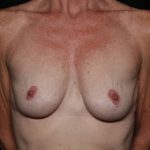 Breast Lift Before & After Patient #35680