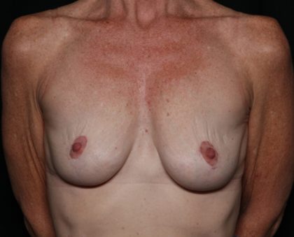 Breast Lift Before & After Patient #35680