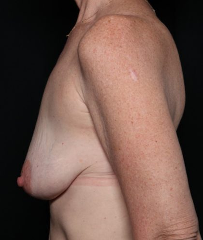 Breast Lift Before & After Patient #35680
