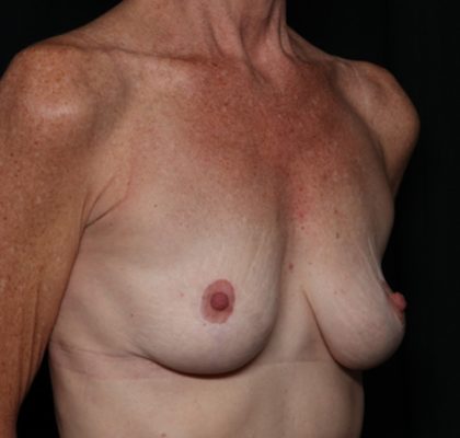 Breast Lift Before & After Patient #35680
