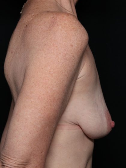 Breast Lift Before & After Patient #35680