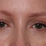 Blepharoplasty Before & After Patient #35691