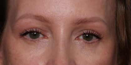 Blepharoplasty Before & After Patient #35691