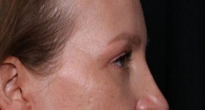 Blepharoplasty Before & After Patient #35691
