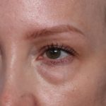 Blepharoplasty Before & After Patient #35691