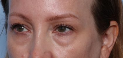 Blepharoplasty Before & After Patient #35691