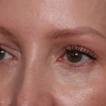 Blepharoplasty Before & After Patient #35691