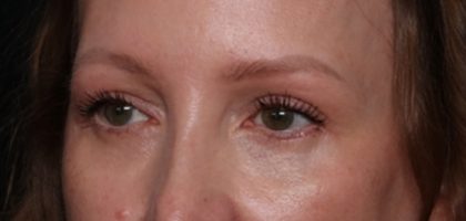 Blepharoplasty Before & After Patient #35691