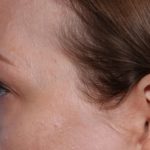 Blepharoplasty Before & After Patient #35691