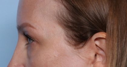 Blepharoplasty Before & After Patient #35691