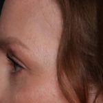 Blepharoplasty Before & After Patient #35691