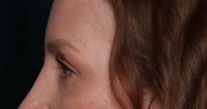 Blepharoplasty Before & After Patient #35691