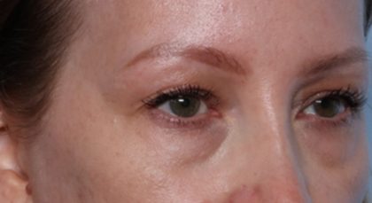 Blepharoplasty Before & After Patient #35691
