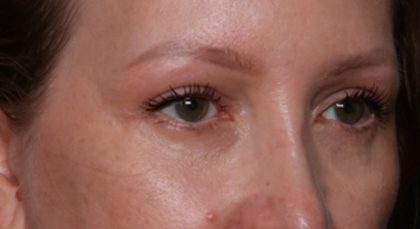 Blepharoplasty Before & After Patient #35691
