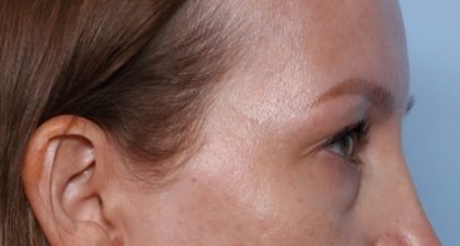 Blepharoplasty Before & After Patient #35691
