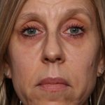 Botox and Dysport Before & After Patient #35607