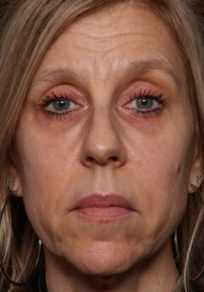 Botox and Dysport Before & After Patient #35607