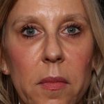 Botox and Dysport Before & After Patient #35607