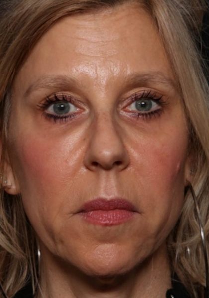 Botox and Dysport Before & After Patient #35607