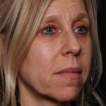Botox and Dysport Before & After Patient #35607