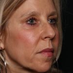 Botox and Dysport Before & After Patient #35607